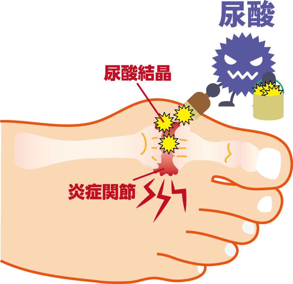 痛風発作のイラスト